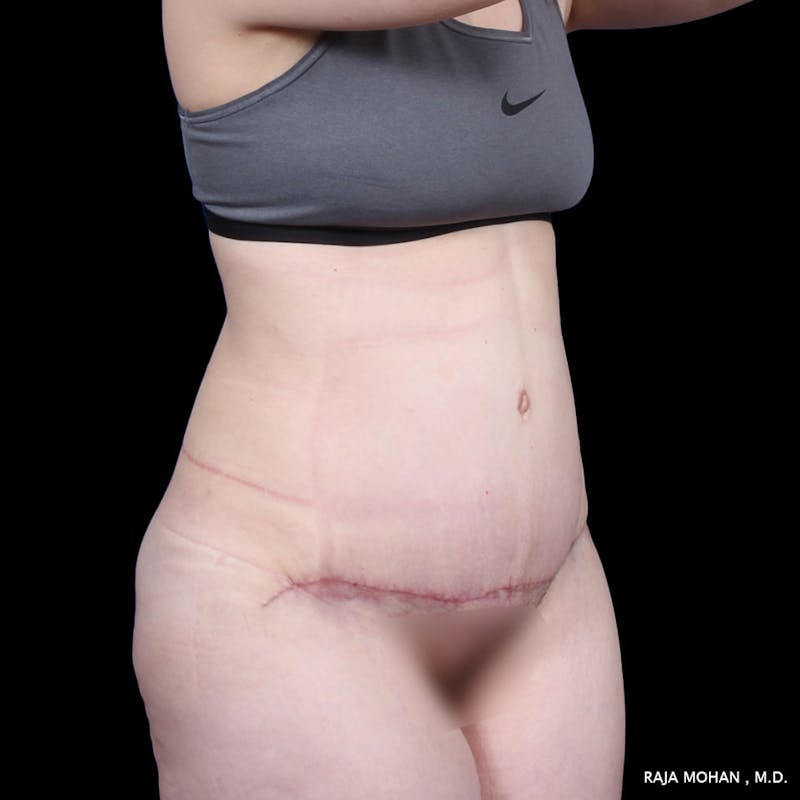 Tummy Tuck Before & After Gallery - Patient 277132 - Image 10