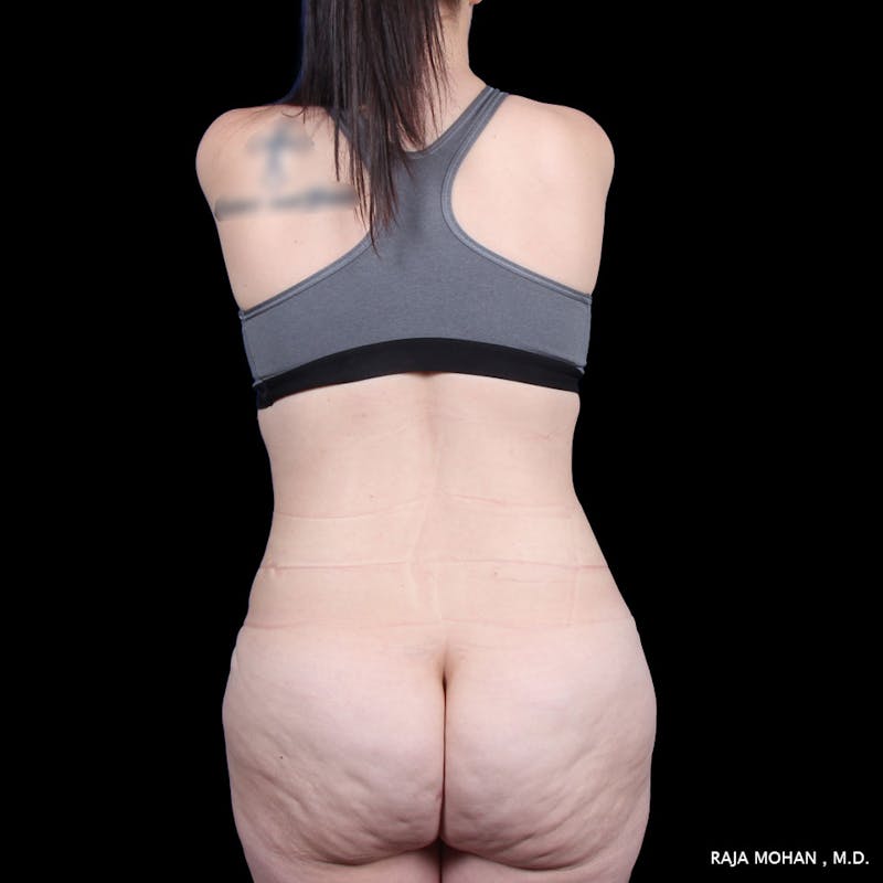Tummy Tuck Before & After Gallery - Patient 277132 - Image 12