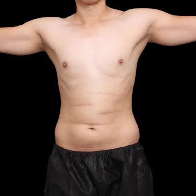 Tummy Tuck Before & After Gallery - Patient 172742 - Image 1
