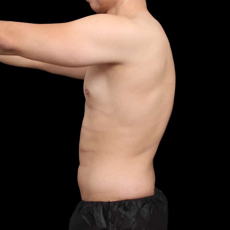 Tummy Tuck Before & After Gallery - Patient 172742 - Image 3