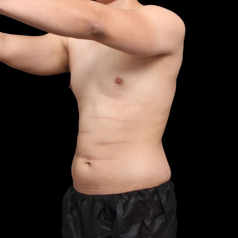 Tummy Tuck Before & After Gallery - Patient 172742 - Image 5