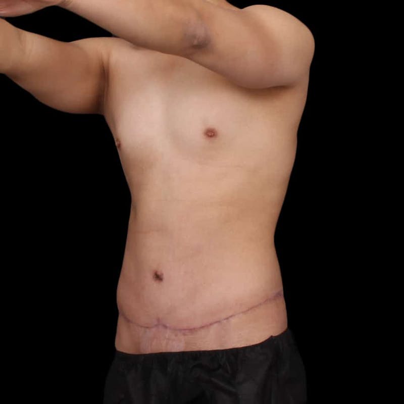 Tummy Tuck Before & After Gallery - Patient 172742 - Image 6