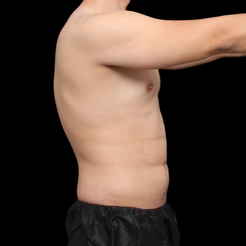 Tummy Tuck Before & After Gallery - Patient 172742 - Image 7