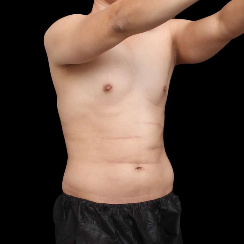 Tummy Tuck Before & After Gallery - Patient 172742 - Image 9