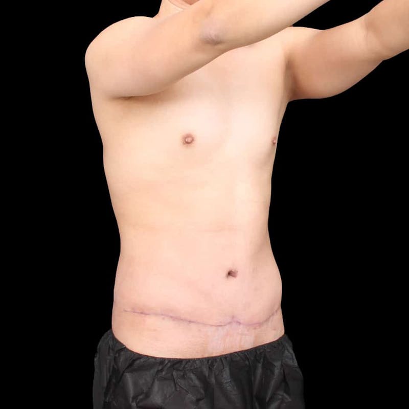 Tummy Tuck Before & After Gallery - Patient 172742 - Image 10