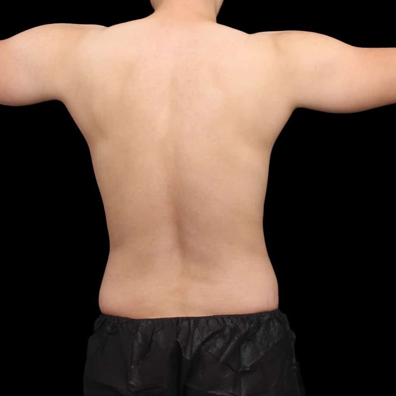 Tummy Tuck Before & After Gallery - Patient 172742 - Image 11