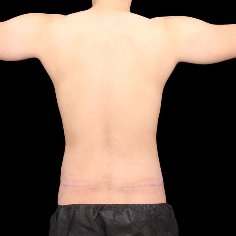 Tummy Tuck Before & After Gallery - Patient 172742 - Image 12