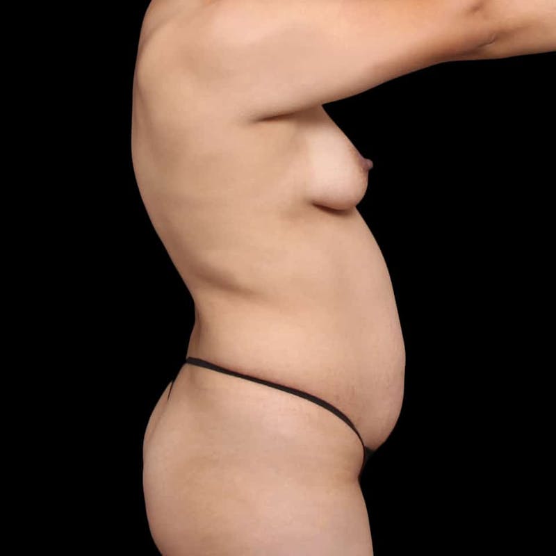 Tummy Tuck Before & After Gallery - Patient 269738 - Image 9
