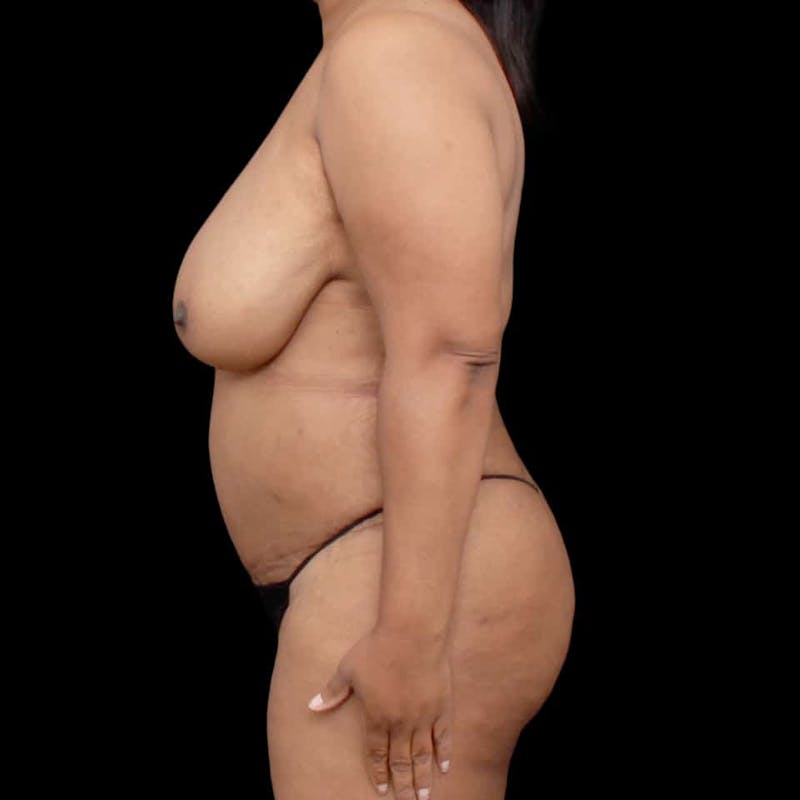 Tummy Tuck Before & After Gallery - Patient 184672 - Image 6