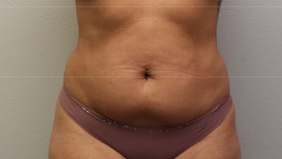 Mommy Makeover Before & After Gallery - Patient 926328 - Image 1