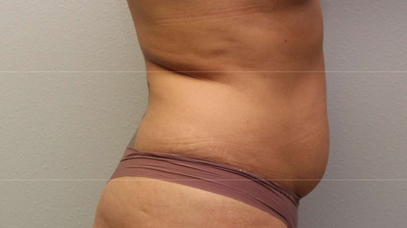 Mommy Makeover Before & After Gallery - Patient 926328 - Image 5