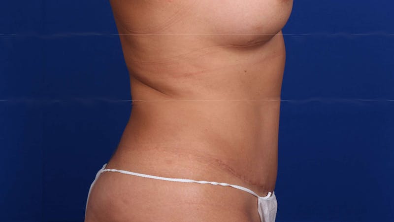 Mommy Makeover Before & After Gallery - Patient 926328 - Image 6