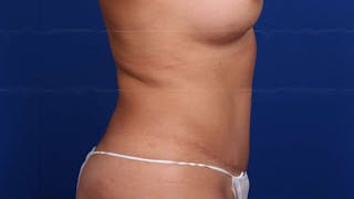Mommy Makeover Before & After Gallery - Patient 384505 - Image 58