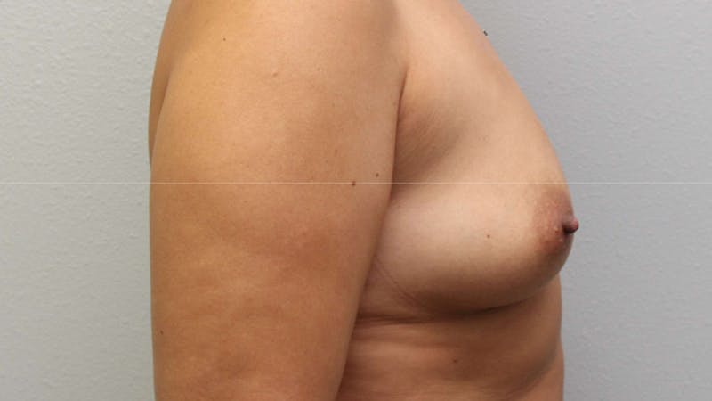 Mommy Makeover Before & After Gallery - Patient 926328 - Image 7