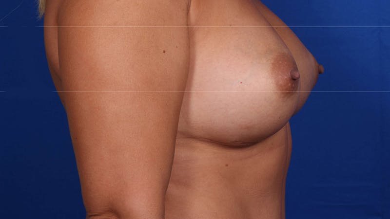 Mommy Makeover Before & After Gallery - Patient 926328 - Image 8