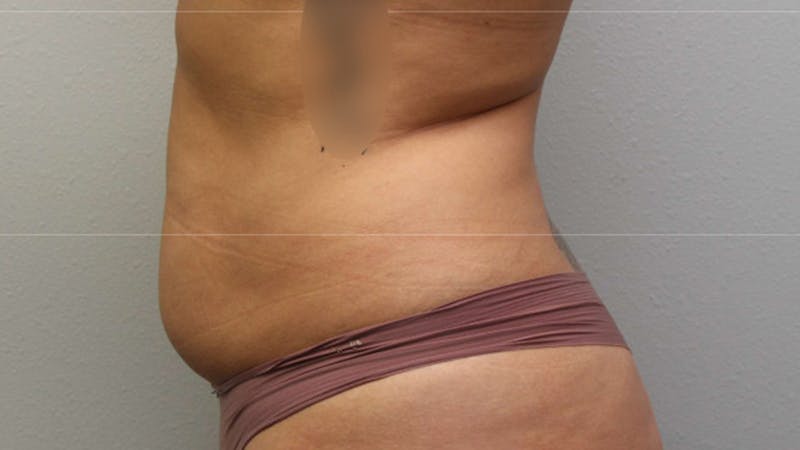 Mommy Makeover Before & After Gallery - Patient 926328 - Image 9