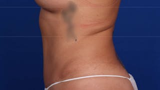 Mommy Makeover Before & After Gallery - Patient 384505 - Image 62