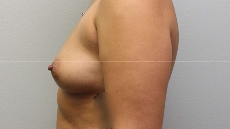 Mommy Makeover Before & After Gallery - Patient 926328 - Image 11