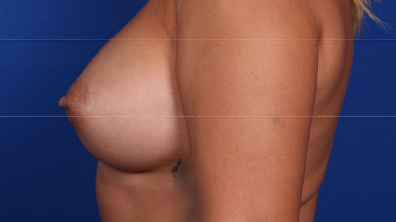 Mommy Makeover Before & After Gallery - Patient 926328 - Image 12