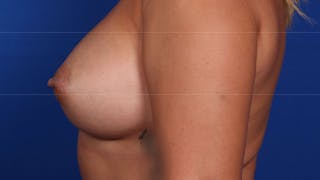 Mommy Makeover Before & After Gallery - Patient 384505 - Image 64