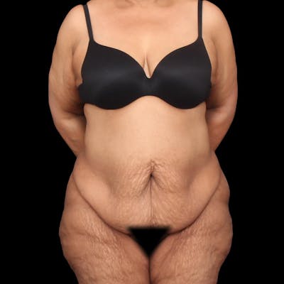 Mommy Makeover Before & After Gallery - Patient 180740 - Image 1