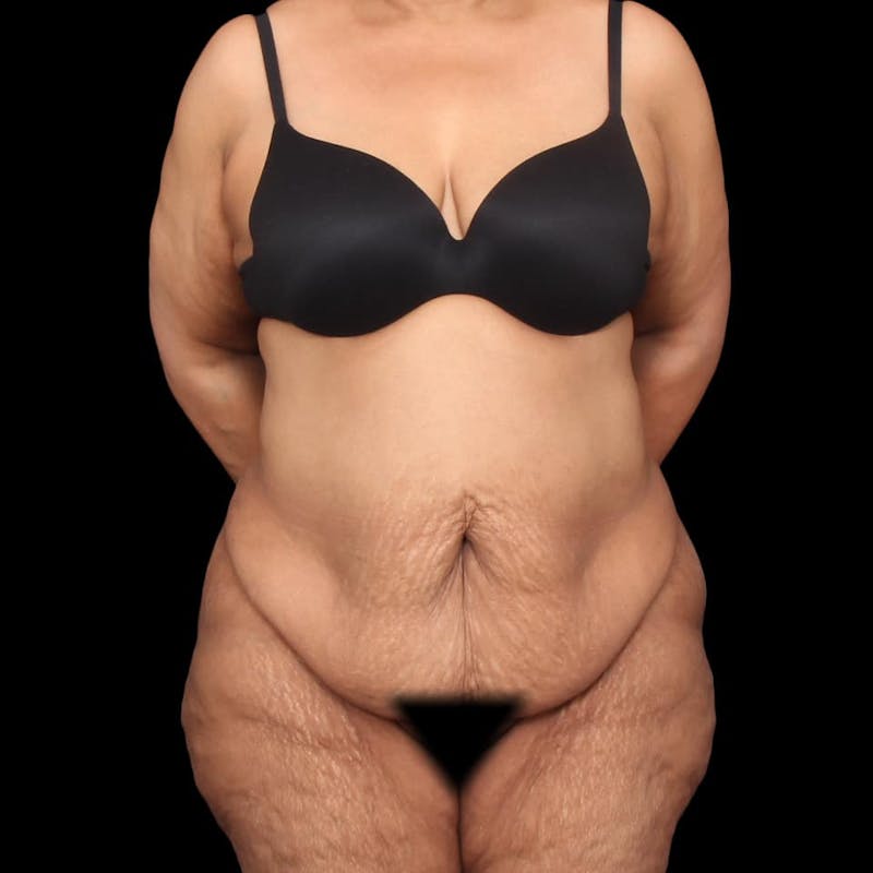 Mommy Makeover Before & After Gallery - Patient 180740 - Image 1