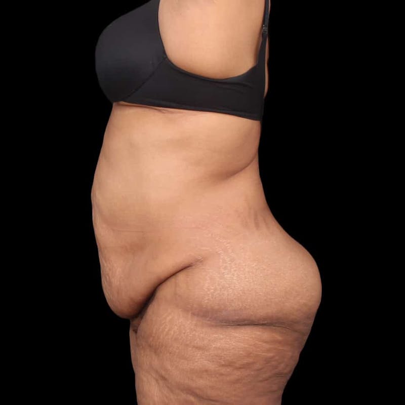 Mommy Makeover Before & After Gallery - Patient 180740 - Image 3
