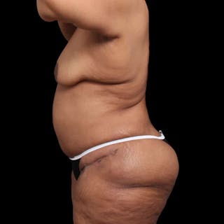 Mommy Makeover Before & After Gallery - Patient 180740 - Image 4