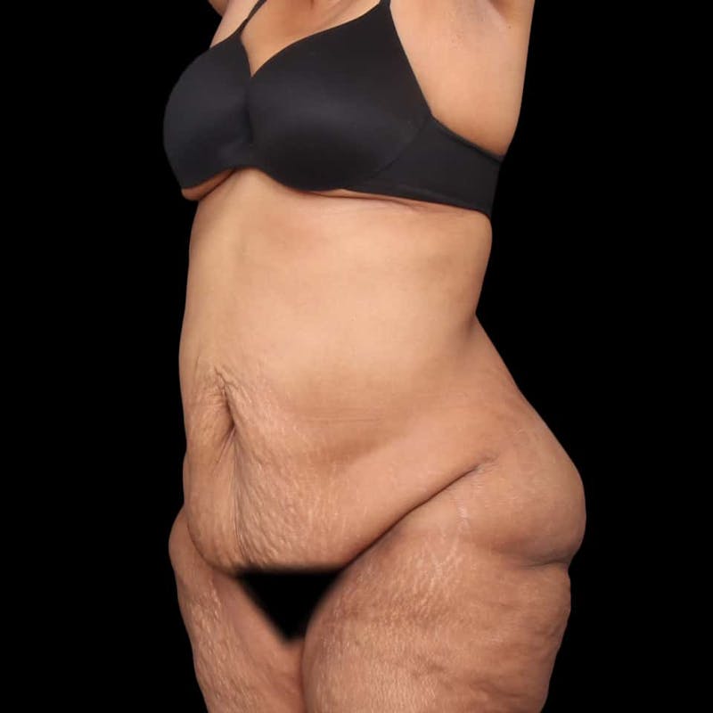 Mommy Makeover Before & After Gallery - Patient 180740 - Image 5
