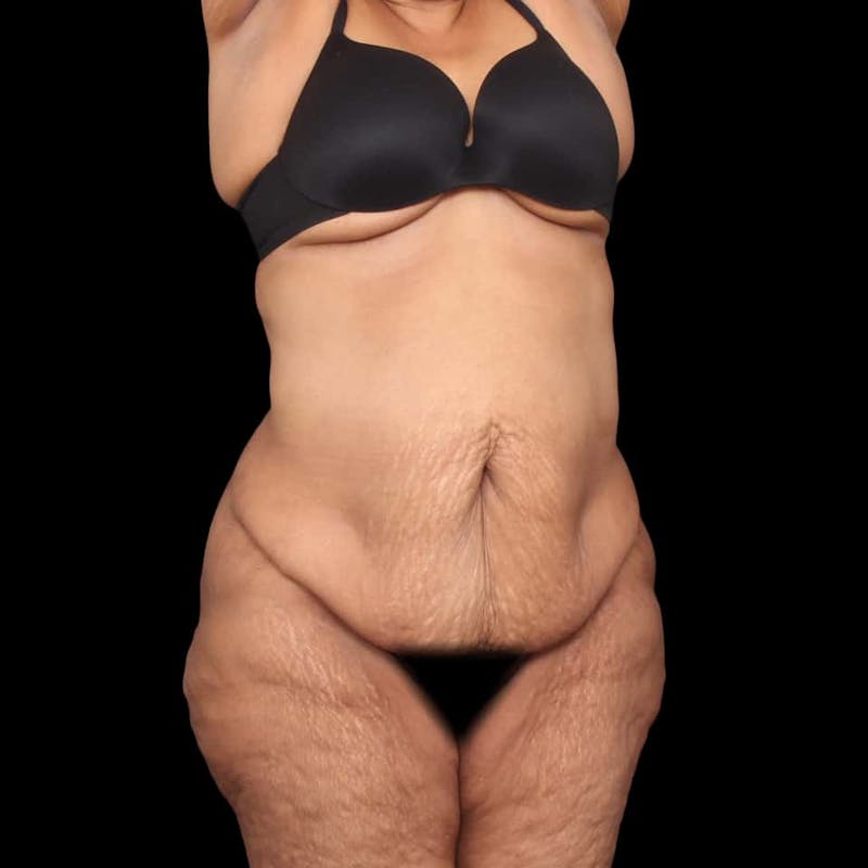 Mommy Makeover Before & After Gallery - Patient 180740 - Image 7