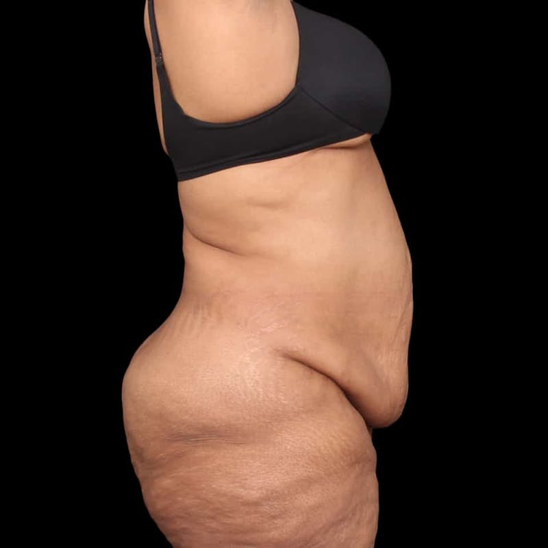 Mommy Makeover Before & After Gallery - Patient 180740 - Image 9