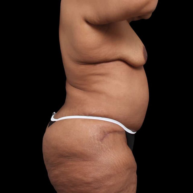 Mommy Makeover Before & After Gallery - Patient 180740 - Image 10