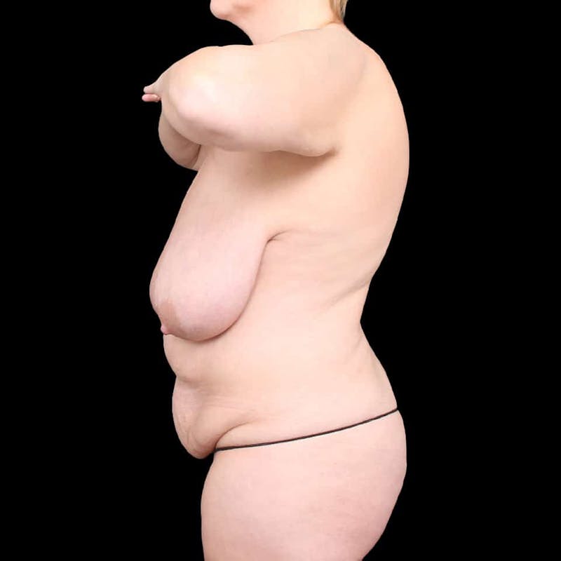 Mommy Makeover Before & After Gallery - Patient 267069 - Image 3