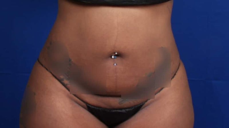 Mommy Makeover Before & After Gallery - Patient 384505 - Image 41
