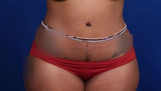 Mommy Makeover Before & After Gallery - Patient 384505 - Image 42