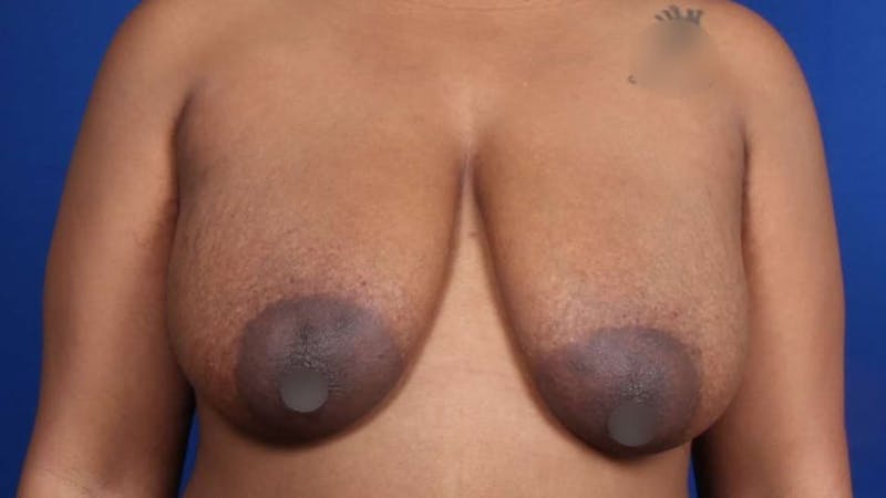 Mommy Makeover Before & After Gallery - Patient 384505 - Image 43