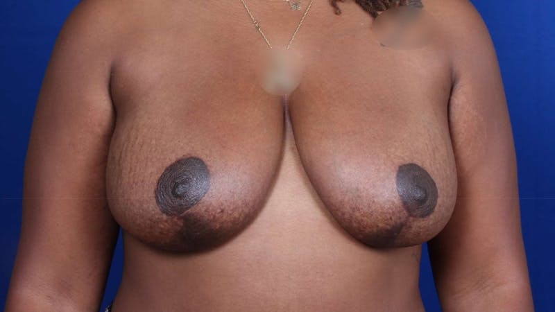Mommy Makeover Before & After Gallery - Patient 384505 - Image 44