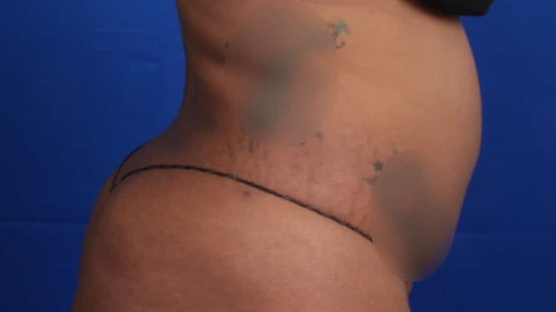 Mommy Makeover Before & After Gallery - Patient 384505 - Image 45