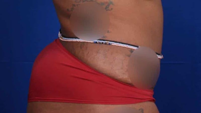 Mommy Makeover Before & After Gallery - Patient 384505 - Image 46