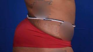 Mommy Makeover Before & After Gallery - Patient 384505 - Image 46