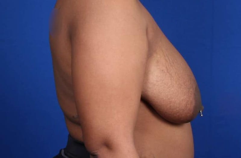 Mommy Makeover Before & After Gallery - Patient 384505 - Image 47