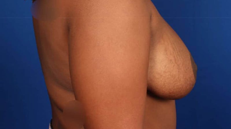 Mommy Makeover Before & After Gallery - Patient 384505 - Image 48