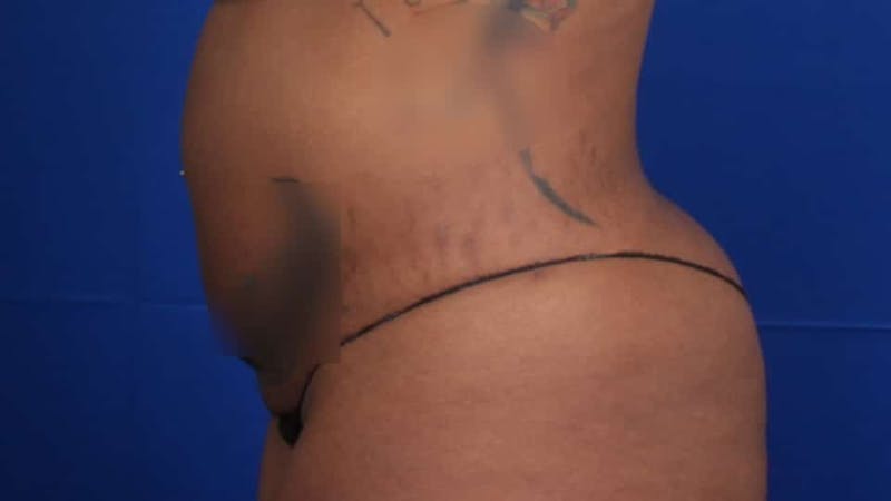 Mommy Makeover Before & After Gallery - Patient 384505 - Image 49