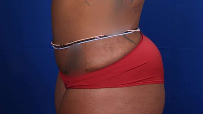 Mommy Makeover Before & After Gallery - Patient 384505 - Image 50