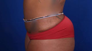 Mommy Makeover Before & After Gallery - Patient 384505 - Image 50