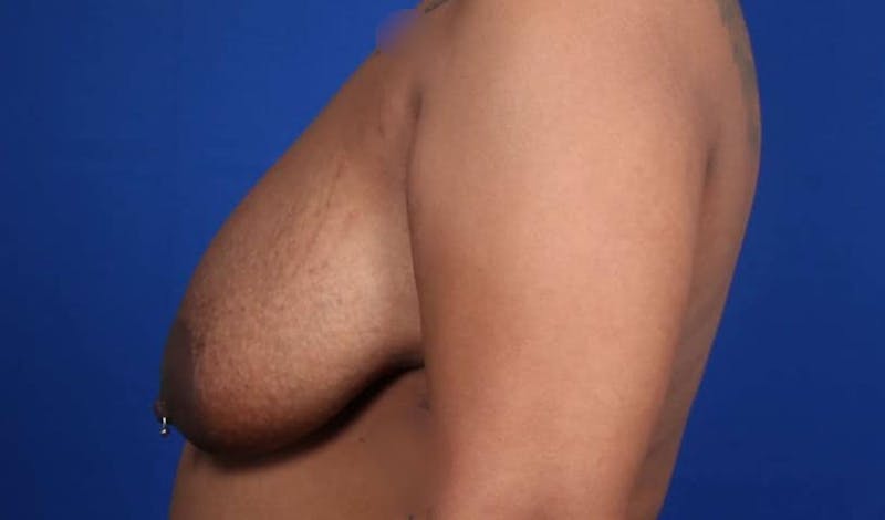 Mommy Makeover Before & After Gallery - Patient 384505 - Image 51