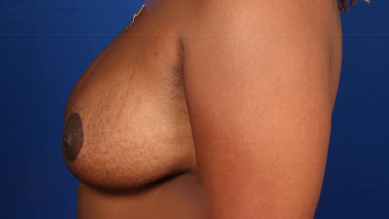 Mommy Makeover Before & After Gallery - Patient 384505 - Image 52