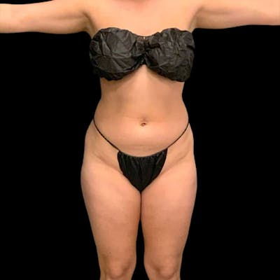 High Definition Lipo Before & After Gallery - Patient 197981 - Image 1
