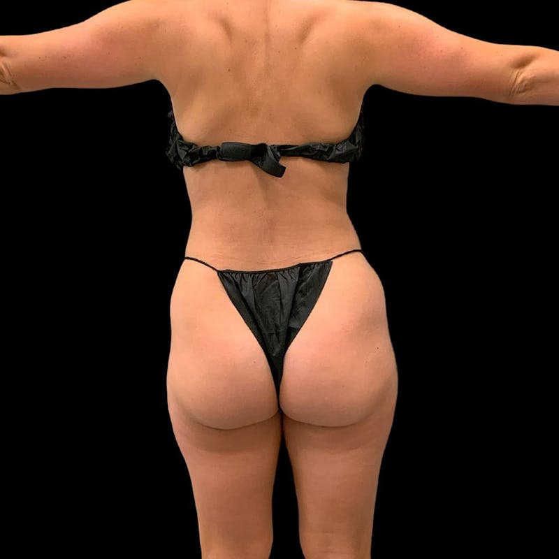 High Definition Lipo Before & After Gallery - Patient 197981 - Image 4