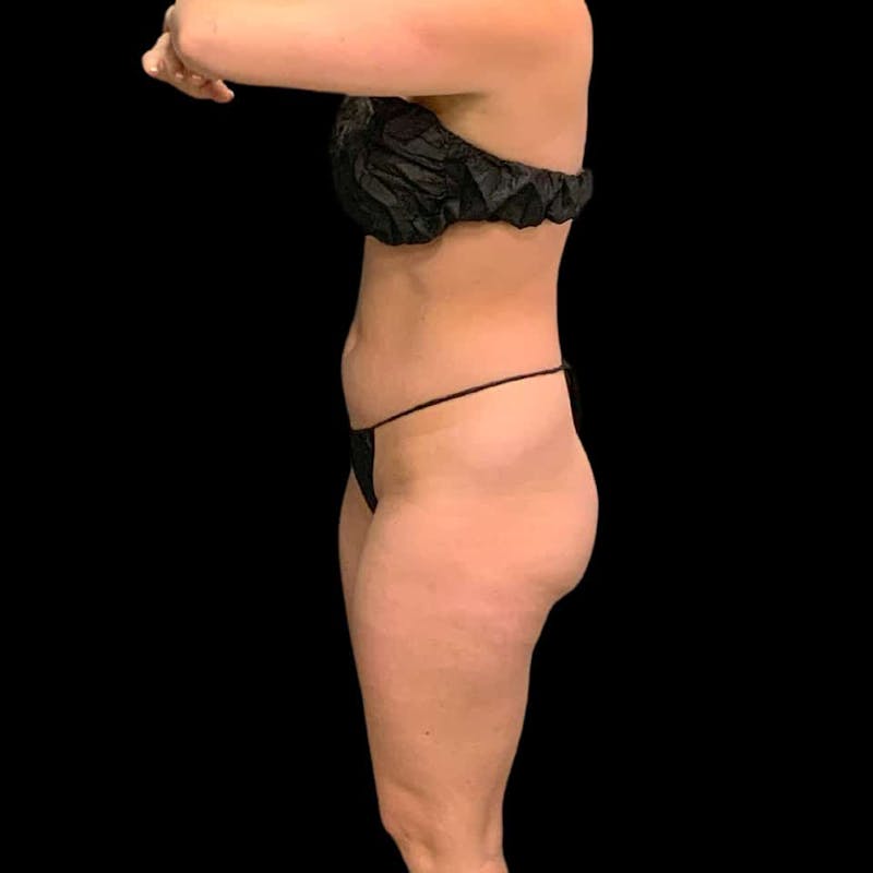 High Definition Lipo Before & After Gallery - Patient 197981 - Image 5
